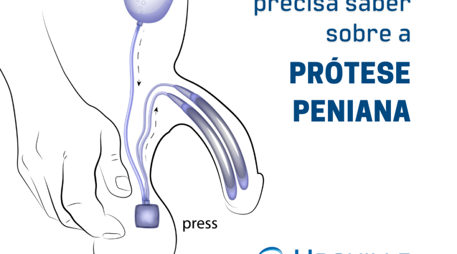 Como é a prótese peniana