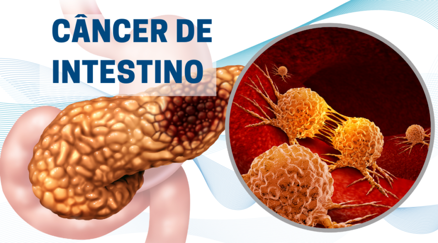 Câncer de intestino