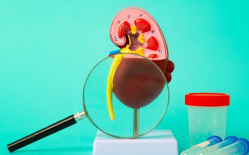 Diagnóstico de Cálculo Renal em Curitiba Como Identificar e Tratar com o Dr. Matheus Pupulin