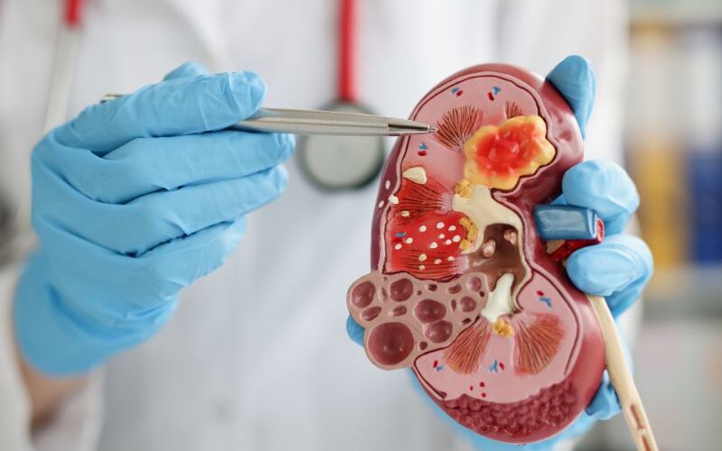 Tratamento de Cálculo Renal em Curitiba Tecnologia e Experiência com o Dr. Matheus Pupulin
